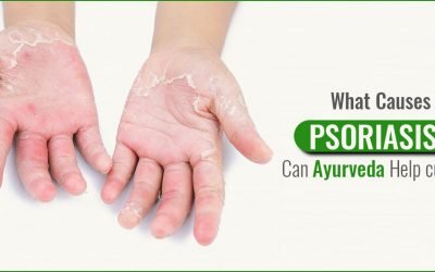 WHAT CAUSES PSORIASIS? CAN AYURVEDA HELP CURE IT?